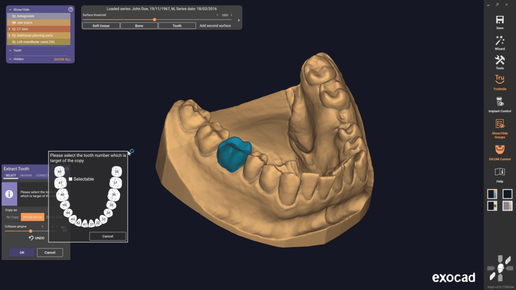 Exocad, solution logicielle CAD CAM pour la CAO dentaire