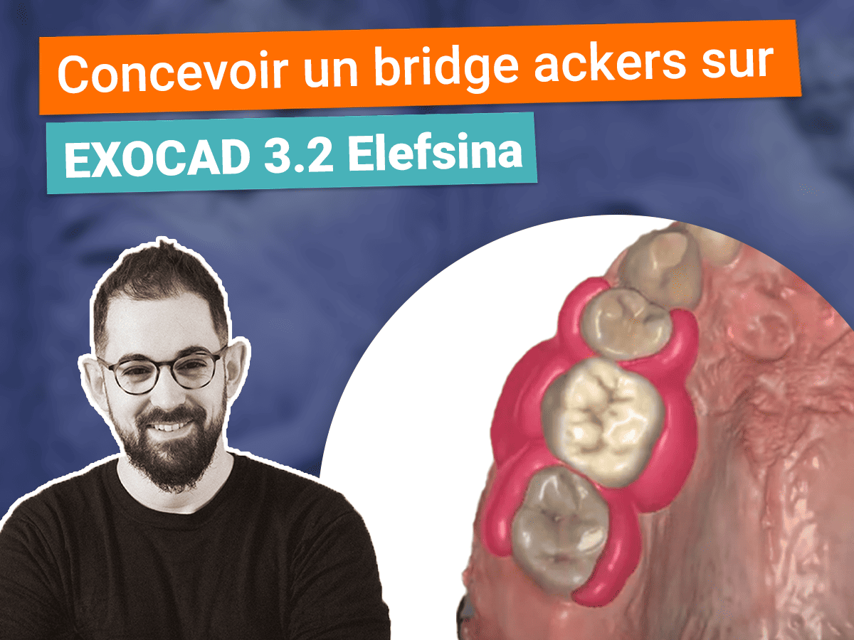 Miniature Comment concevoir un bridge ackers sur Exocad 3.2 Elefsina