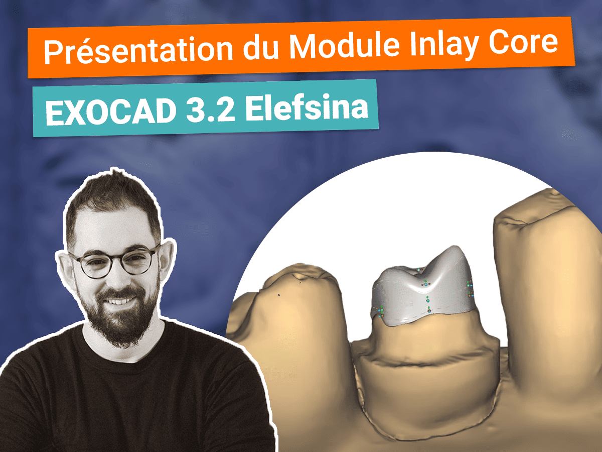 Miniature présentation du module inlay core sur Exocad 3.2 elefsina