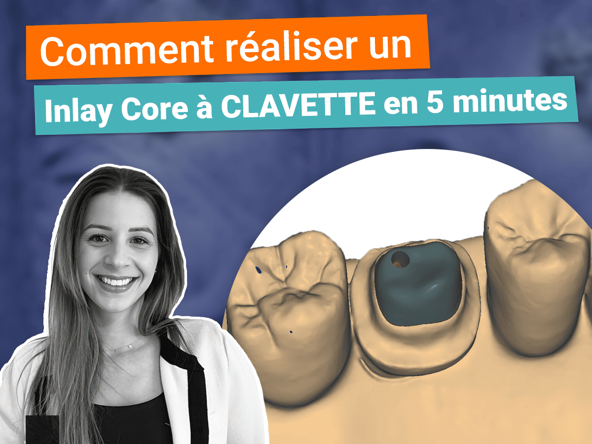 inlay core à clavette sur exocad elefsina 3.2