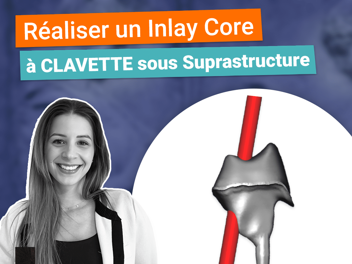 inlay core à clavette sous suprastructure sur Exocad