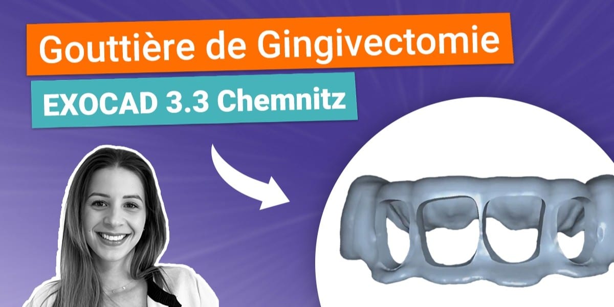 Comment concevoir une gouttière de gingivectomie directement dans Exocad, étape par étape.