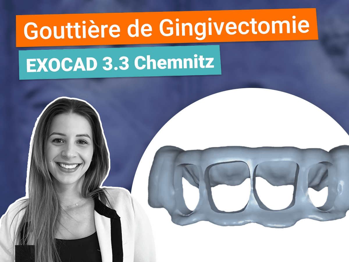 Faire une gouttière de gingivectomie sur Exocda 3.3 chemnitz